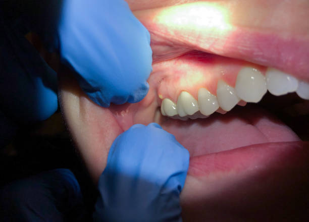 Best Emergency Dentist for Knocked-Out Tooth in Verona, PA